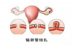 女性结扎后，还能做试管婴儿生育吗？