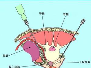 腹腔积液，去美国做试管婴儿成功率高吗？