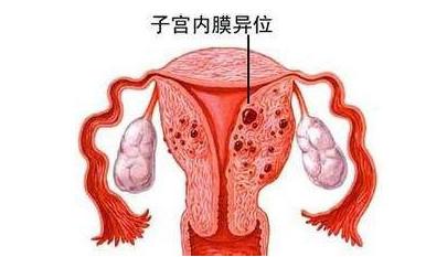  诺优笙国际：子宫内膜异位，美国试管助孕好孕率？