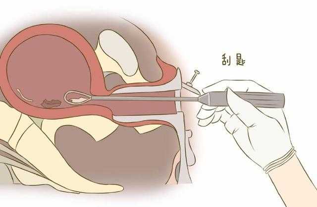 诺优笙国际：刮宫对试管成功率会有影响吗？